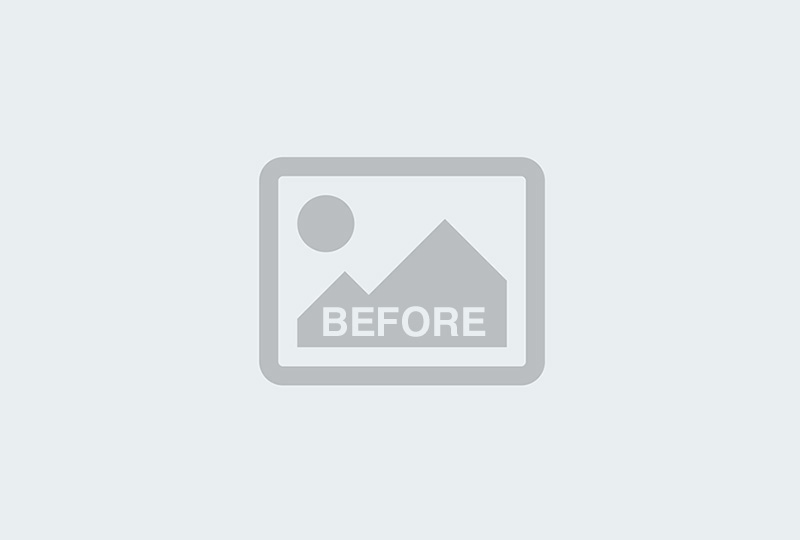 Before Image: Male Tummy Tuck Patient 1 - front