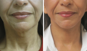 woman’s chin and neck before and after neck lift procedure, turkey neck gone afterwards