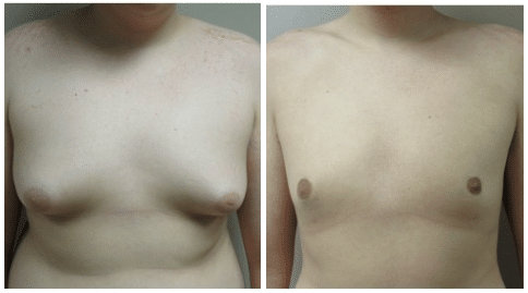 Gynecomastia Before & After Photo San Antonio TX