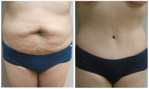 Tummy Tuck before & after patient