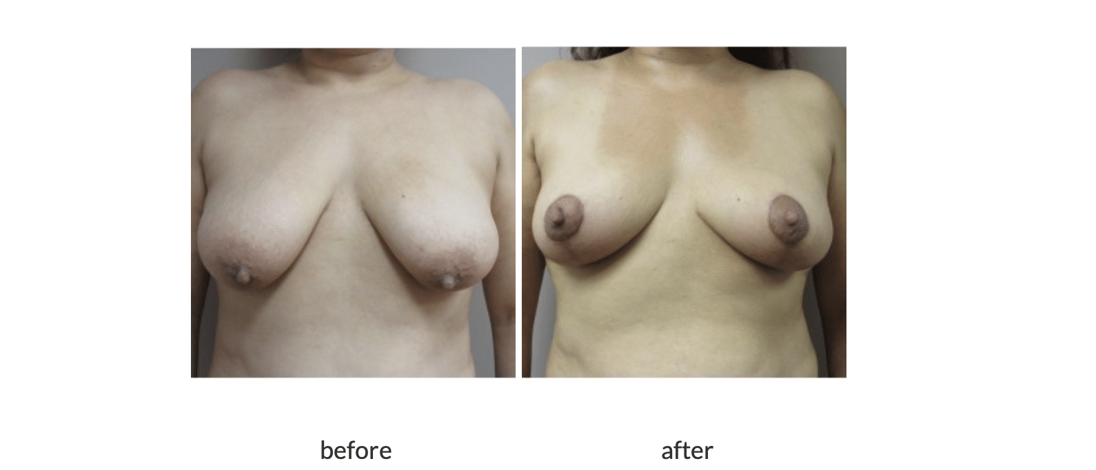 Breast reduction before and after