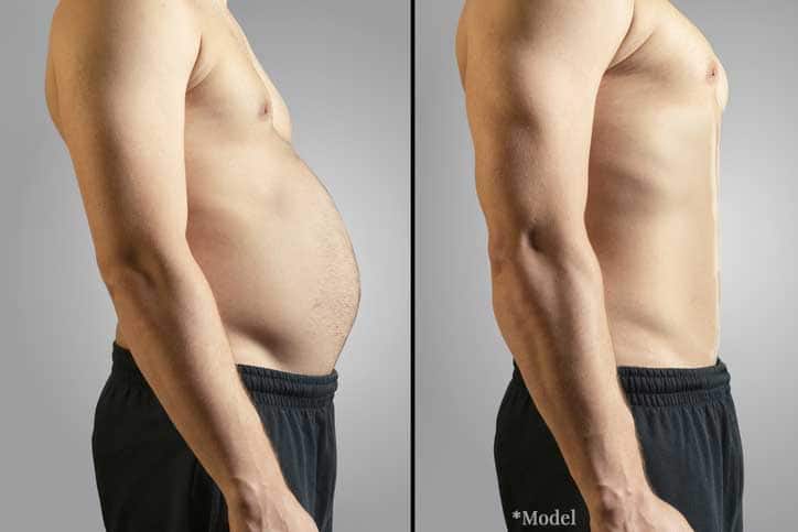 man before and after liposuction with flatter stomach after procedure