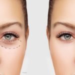 Eyelid Surgery