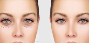 Eyelid Surgery