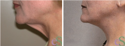 a side profile before and after image set of a woman that received a neck lift