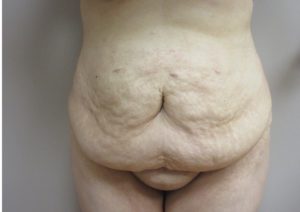 woman’s bare stomach before tummy tuck/abdominoplasty