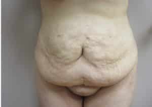 woman’s bare stomach before tummy tuck/abdominoplasty