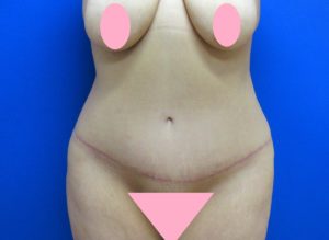 topless woman after tummy tuck, stomach flatter after procedure