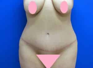 After Tummy Tuck San Antonio TX