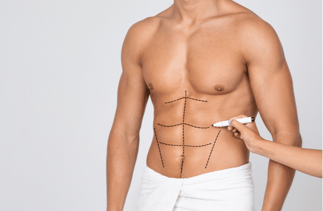Tummy Tuck Exclusively Designed for Men - Eric S. Schaffer, MD FACS