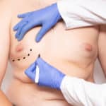 surgeon preparation before surgery to reduce breasts in men, gynecomastia