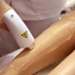 Laser Hair Removal