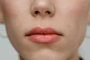 Lip Enhancement