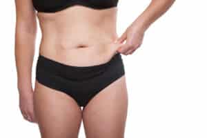 Cropped,Shot,Body,Woman,With,Excess,Weight,And,Subcutaneous,Fat.