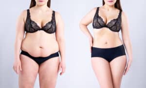 Before and after tummy tuck and lipo in San Antonio