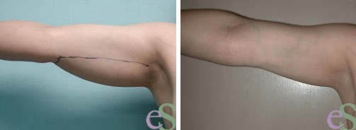 Arm Lift before and after patient photo Arm Lift before and after patient photo