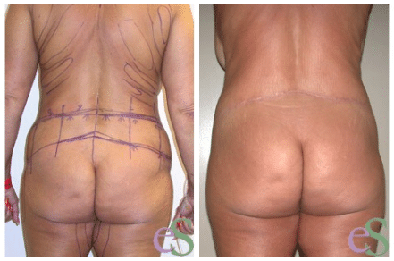 Buttock Back Lift Patient before after