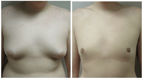 Gynecomastia before and after photo