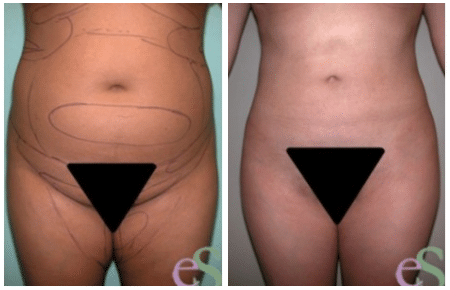 Liposuction before and after photo