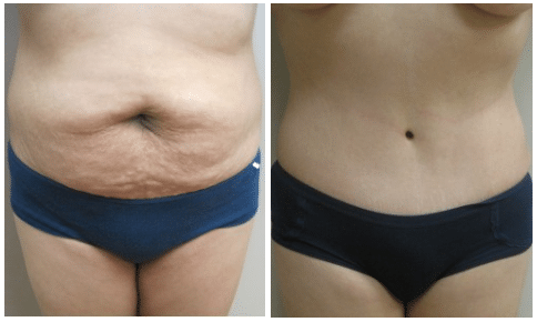 Tummy Tuck Before After Patient