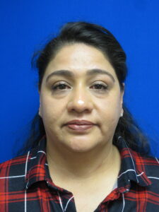 Before Image: Blepharoplasty Patient 12