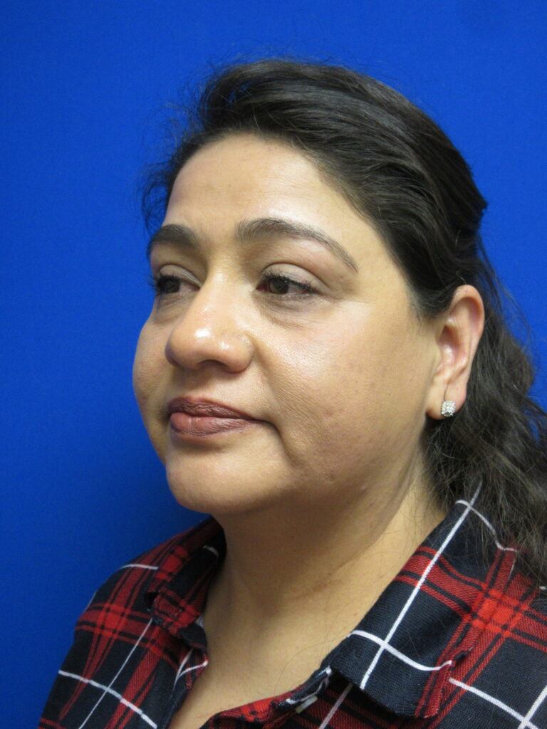 Before Image: Blepharoplasty Patient 12 - left-front-oblique