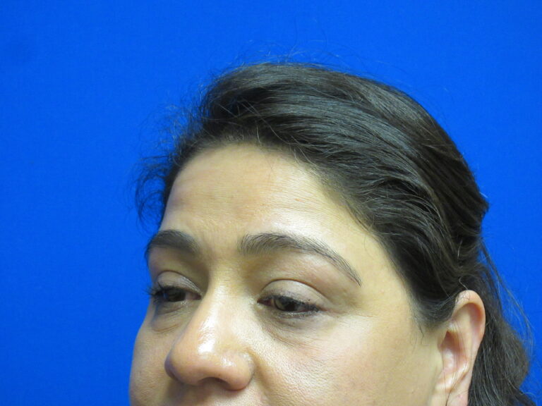 Before Image: Blepharoplasty Patient 12 - left-front-oblique
