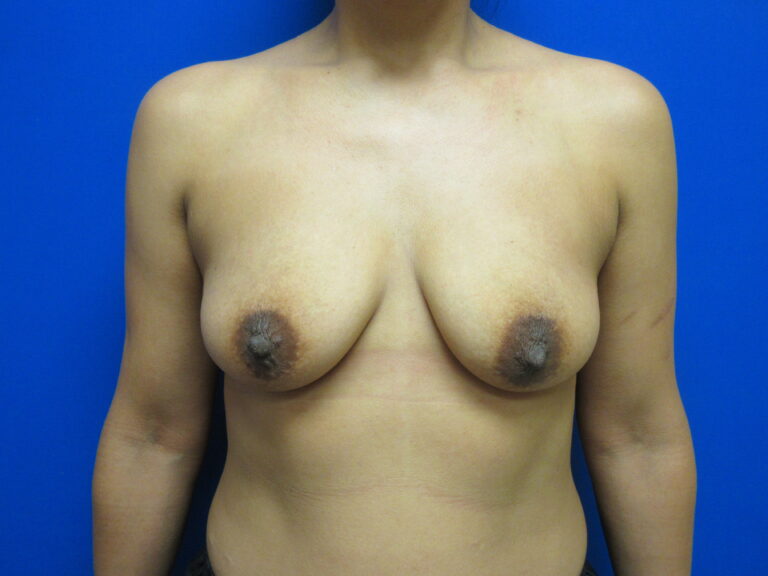 Before Image: Breast Augmentation Patient 163 - front