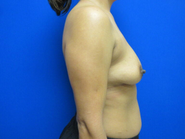 Before Image: Breast Augmentation Patient 163 - right-side