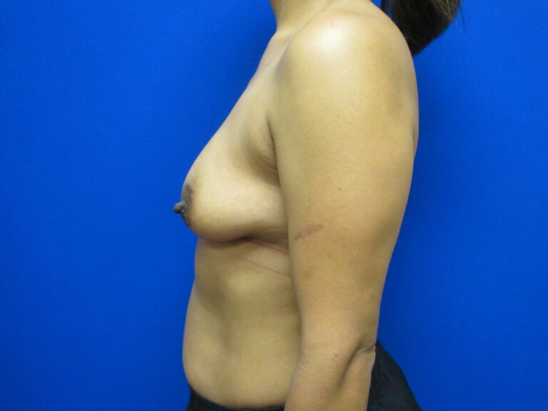 Before Image: Breast Augmentation Patient 163 - left-side