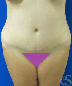 After Image: Tummy Tuck Patient 60