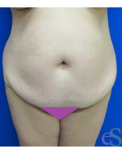 Before Image: Tummy Tuck Patient 60