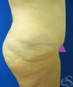 After Image: Tummy Tuck Patient 60 - right-side
