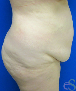 Before Image: Tummy Tuck Patient 60 - right-side