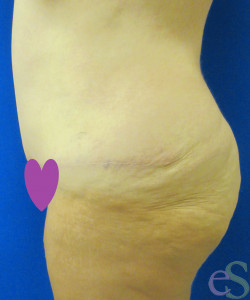 After Image: Tummy Tuck Patient 60 - left-side