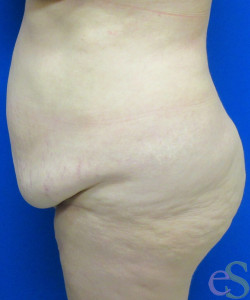 Before Image: Tummy Tuck Patient 60 - left-side