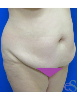 Before Image: Tummy Tuck Patient 60 - right-front-oblique