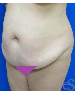 Before Image: Tummy Tuck Patient 60 - left-front-oblique