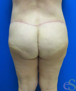 After Image: Lower Back Lift Patient 4 - back