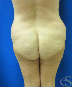 Before Image: Lower Back Lift Patient 4 - back