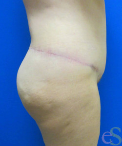 After Image: Lower Back Lift Patient 4 - right-side