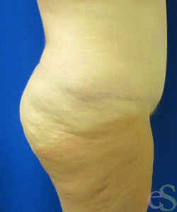 Before Image: Lower Back Lift Patient 4 - right-side