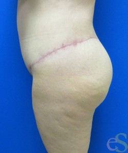 After Image: Lower Back Lift Patient 4 - left-side