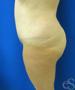 Before Image: Lower Back Lift Patient 4 - left-side