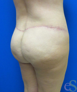 After Image: Lower Back Lift Patient 4 - right-back-oblique