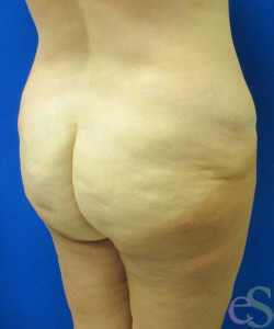 Before Image: Lower Back Lift Patient 4 - right-back-oblique