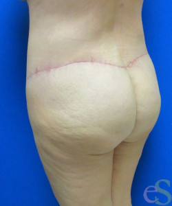 After Image: Lower Back Lift Patient 4 - left-back-oblique