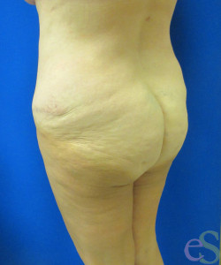 Before Image: Lower Back Lift Patient 4 - left-back-oblique