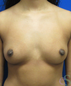 Before Image: Breast Augmentation Patient 162