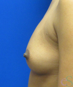 Before Image: Breast Augmentation Patient 162 - left-side